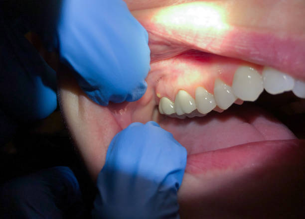 Best Tooth Infection Emergency Dentist  in Hillandale, MD